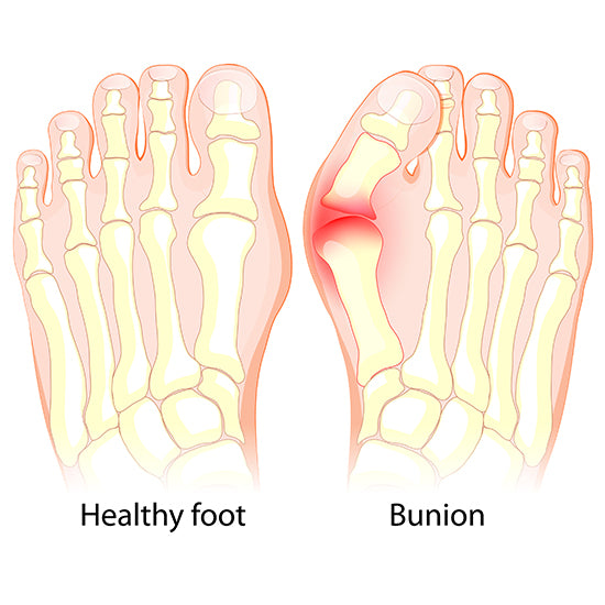 Bunions